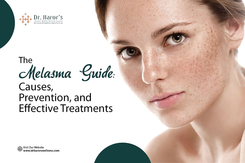 The Melasma Guide: Causes, Prevention, and Effective Treatments